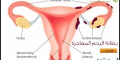 ادوية علاج بطانة الرحم المهاجرة 2026