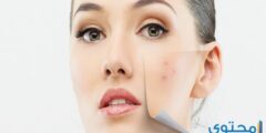 علاج البقع البنية في الوجه بالأدوية 2026