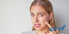 لاسكار جل (lascar gel) الحل لعلاج آثار الحروق وحب الشباب 2026