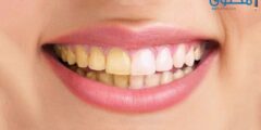 وصفات تبييض الأسنان بطريقة طبيعية 2026
