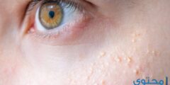 علاج الحبوب البيضاء الصغيرة في الوجه 2026