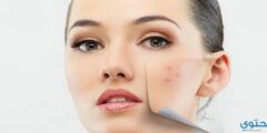 علاج ندبات حب الشباب بخلطات طبيعية 2026